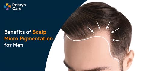 Scalp Micropigmentation For Men Technique Effects Benefits Of It