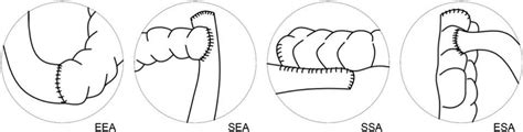 Ileocolonic Anastomosiscomparison Of Different Surgical Tec Medicine