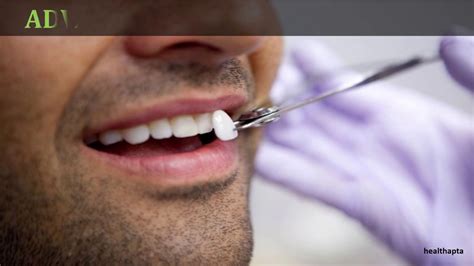 Advantages And Disadvantages Of Dental Veneers Youtube