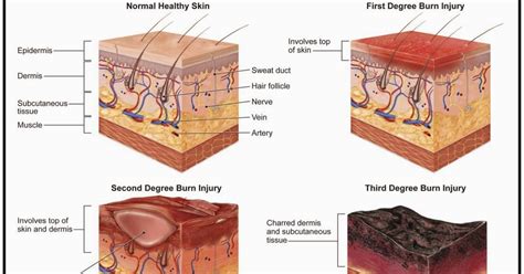 Burn Notice Blog Edition: Diagnosis/Classification of Burns