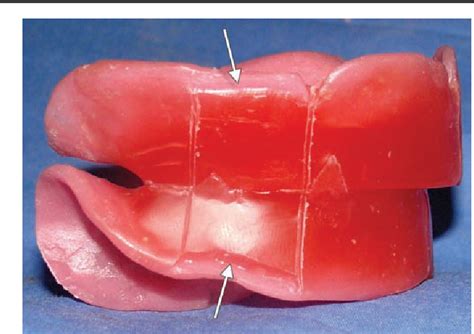 Technique To Stabilize Wax Occlusion Rims Following Maxillomandibular