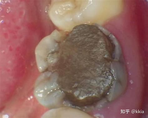 根管治疗后的牙齿崩了怎么办？补牙？牙冠？嵌体？（持续更新） 知乎