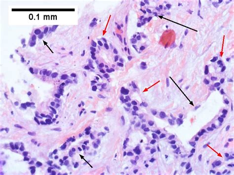 Cholangiocarcinoma Libre Pathology