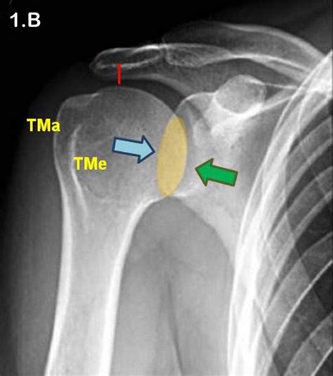 Luxaci N Posterior De Hombro Asepeyo Salud