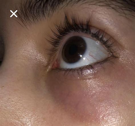 Recurring Rash Around Eyes R Skincareaddicts