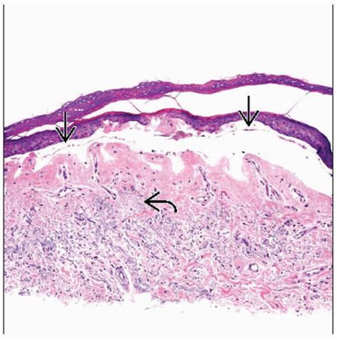 Porphyria Cutanea Tarda | Basicmedical Key