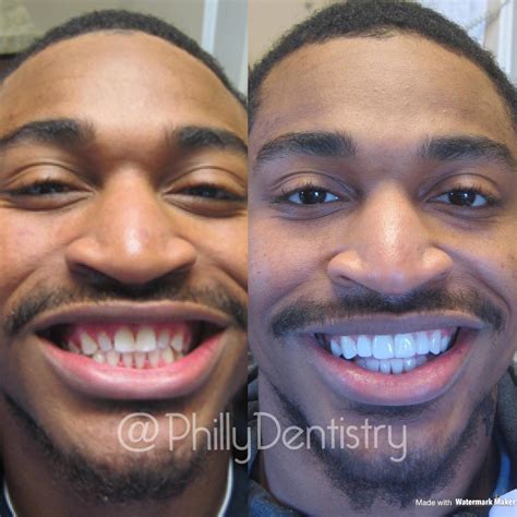 Smile Makeovers Philadelphia Restore Your Perfect Smile