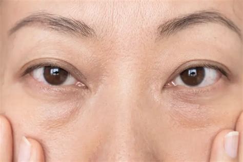 Dark Eye Circles Treatment Evoque Medical Aesthetics