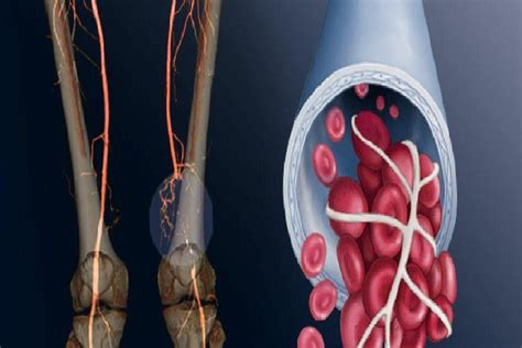 Bacak Ve Kollarda G R Len Rahats Zl K Emboli Emboli Nedir Embolinin