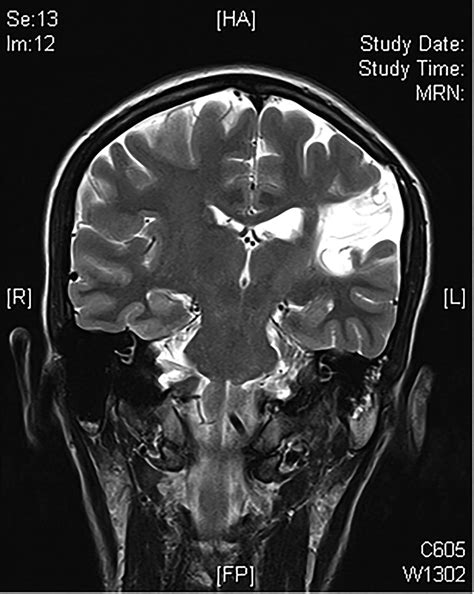 Cerebral Palsy Practical Neurology