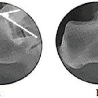 Measurement technique for Bohler angle and the crucial angle of... | Download Scientific Diagram