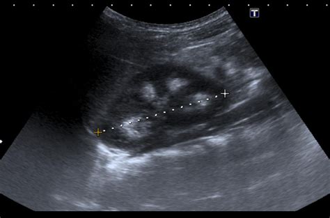 Medullary nephrocalcinosis: Ultrasound - Sumer's Radiology Blog