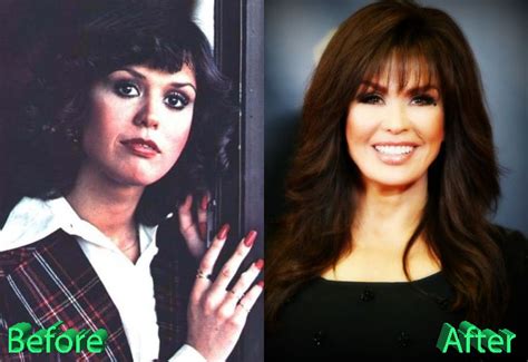 Marie Osmond Before and After Surgery Procedure