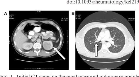 Figure 1 From Prevalence And Management Of Rheumatoid Arthritis In The