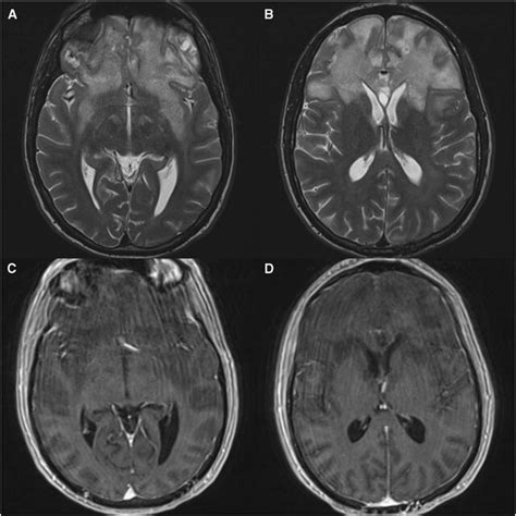 Gadolinium Enhanced Magnetic Resonance Imaging Of The Head 4 Months