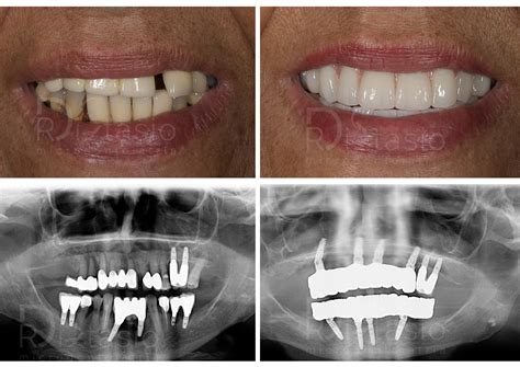 Prima E Dopo Implantologia Foggia Studio Dentistico Di Stasio