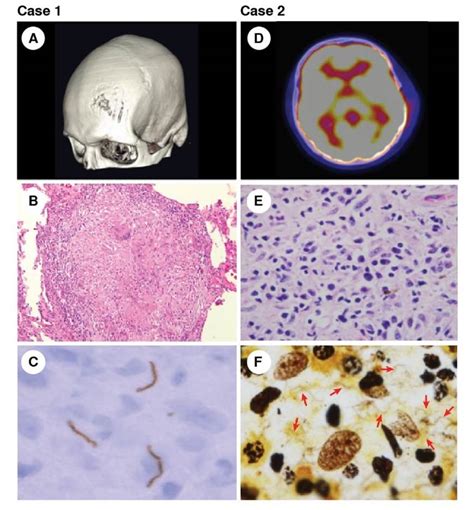 Bone Involvement In Non Congenital Syphilis