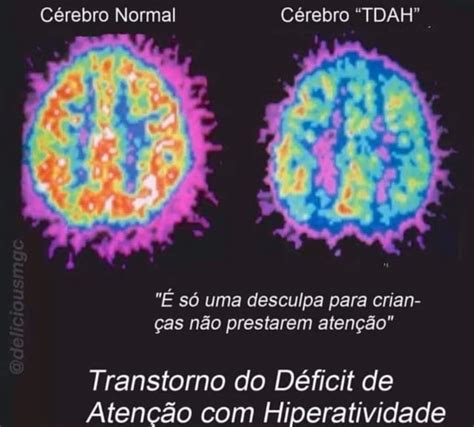 Hiperatividade Cerebral Quando O Corpo Dorme Mas O Cérebro Não - Cérebro Normal Cérebro "TDAH" Transtorno do Déficit de Atenção com ...