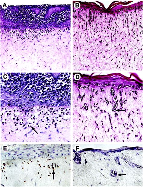 E Cadherin Expression In Melanoma Cells Restores Keratinocyte Mediated