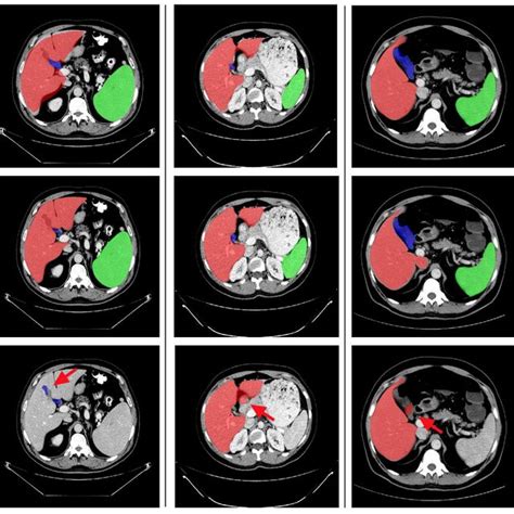 Comparison Of Results Produced By The Multi Organ And Single Organ