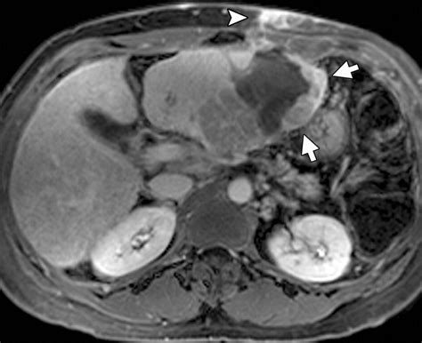 Image Guided Treatment In The Hepatobiliary System Role Of Imaging In