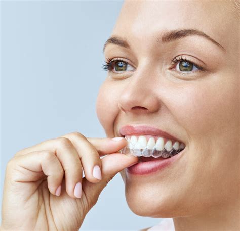 Invisalign Clear Aligners Tfi Connect Dentistry