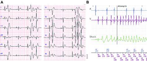 Multifocal Premature Ventricular Contractions