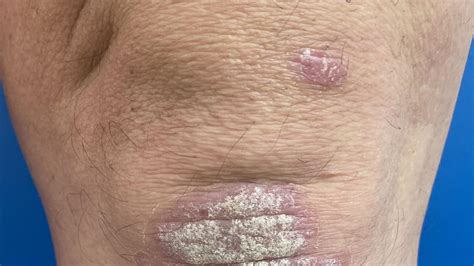 Psoriasis O Artritis Psoriásica Un Abordaje Integral Más Allá De La Piel