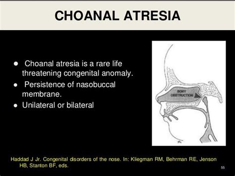 choanal atresia