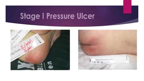 Staging Of Pressure Ulcers Youtube