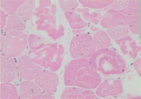 Mechanisms Of Cell Injury Flashcards Quizlet