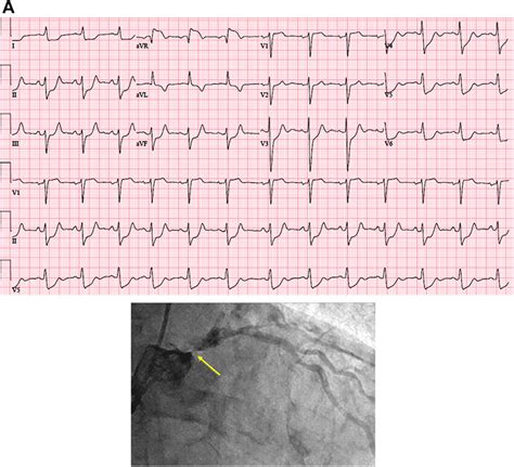 Ecg Of Lmca Occlusion Download Scientific Diagram