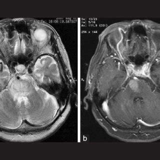 Pontine Venous Congestion Due To Dural Arteriovenous Fistula Of The