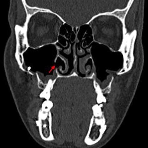 Postoperative coronal CT image showing persistent bony dehiscence at ...