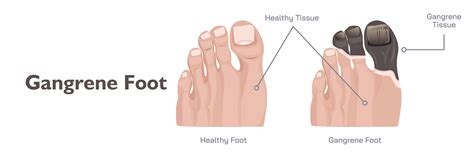 gangrene foot symptoms diagnosis  treatment