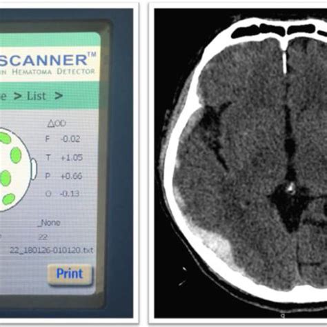 A portable near-infrared spectroscopy (NIRS) components (A) and usage ... 