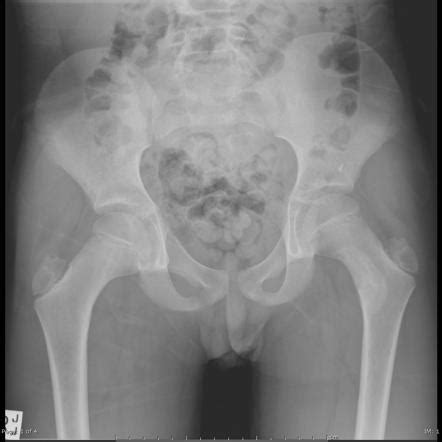 Osteoblastoma Radiology