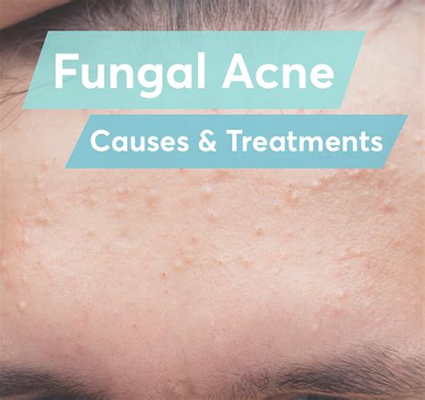 Fungal Acne: Symptoms, Causes, Treatment Options | atelier-yuwa.ciao.jp