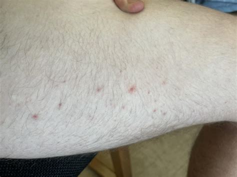 Herpes Or Skin Condition Inner Thigh Rash R Dermatologyquestions