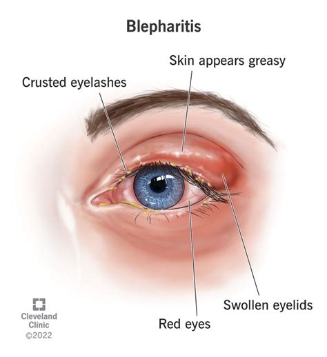 How To Get Rid Of A Swollen Eyelid Causes And Treatment Dr, 50% OFF