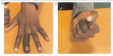 Figure From An Ultra Thinned Groin Flap For Reconstruction Of