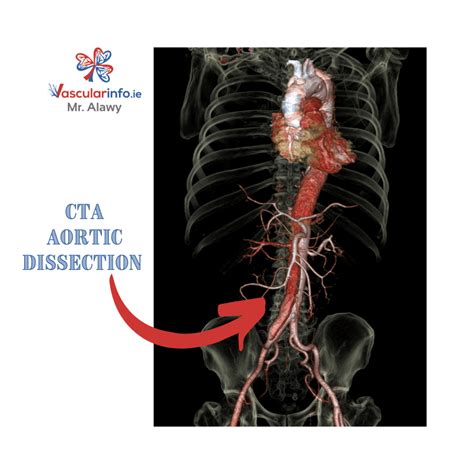 Aortic Dissection – Vascular Info