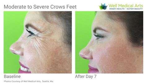 Botox Before And After Crows Feet Well Medical Arts Seattles Anti