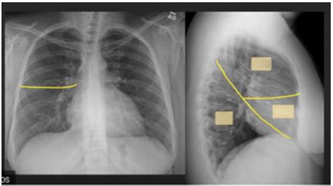 Right Lung Lobes Diagram | Quizlet