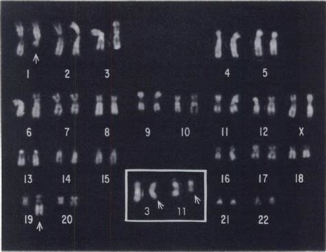 Karyotype With Q Banding Of A Cell From Patient 13 At Diagnosis