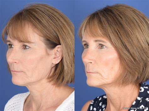 Revision Rhinoplasty Before And After 16 Weber Facial Plastic Surgery