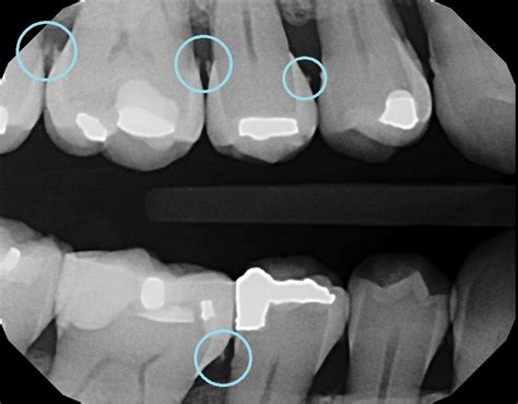 Why Do I Need X Rays Lakes Region Dental Center