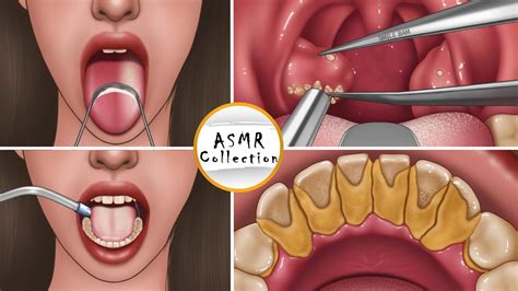 Asmr Extreme Tonsil Stone Treatment And Giant Tartar Removal White Tongue