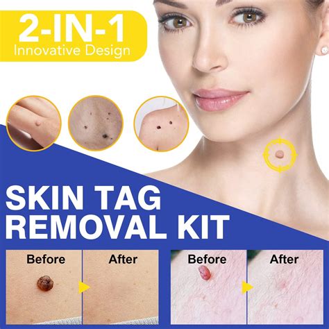 Skin Tag Removal Kit - Skin Tag Remover Patch – mycosmeticslondon