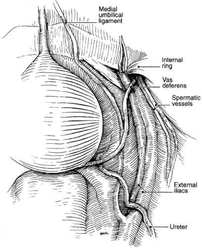 Pelvic Lymph Node Dissection Boundaries